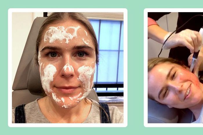 "Microneedling made my skin softer than ever."