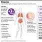 Factfile on measles, a highly contagious disease. An epidemic in Samoa has now claimed 37 lives, according to official data as of Thursday