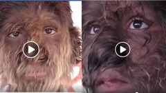 Boy’s rare condition leaves thick hair covering his entire face (video)