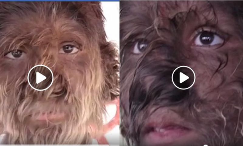 Boy’s rare condition leaves thick hair covering his entire face (video)