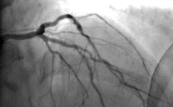 Surgery for Blocked Arteries Is Often Unwarranted, Researchers Find
