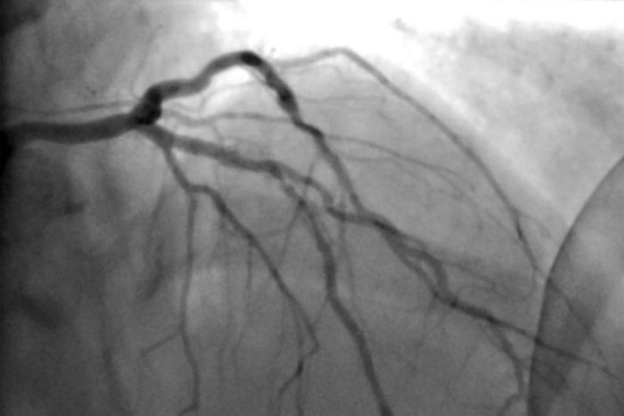 Surgery for Blocked Arteries Is Often Unwarranted, Researchers Find
