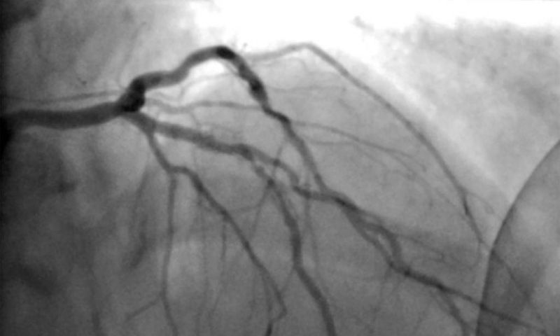 Surgery for Blocked Arteries Is Often Unwarranted, Researchers Find