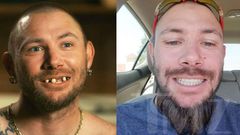 'Tiger King' Star John Finlay Got New Teeth