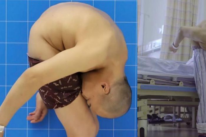 Medical condition makes this man spend 3 decades of his life with his head stuck to his knees