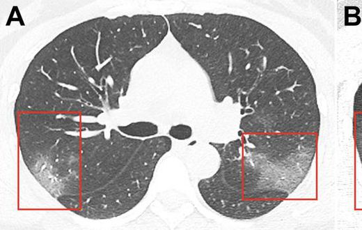 Coronavirus patient chest x ray