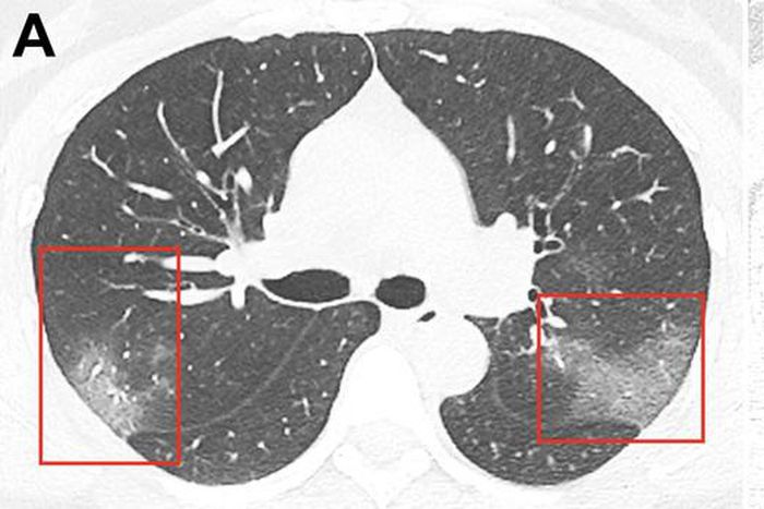 Coronavirus patient chest x ray