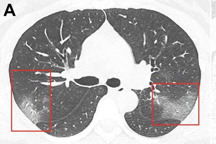 Coronavirus patient chest x ray