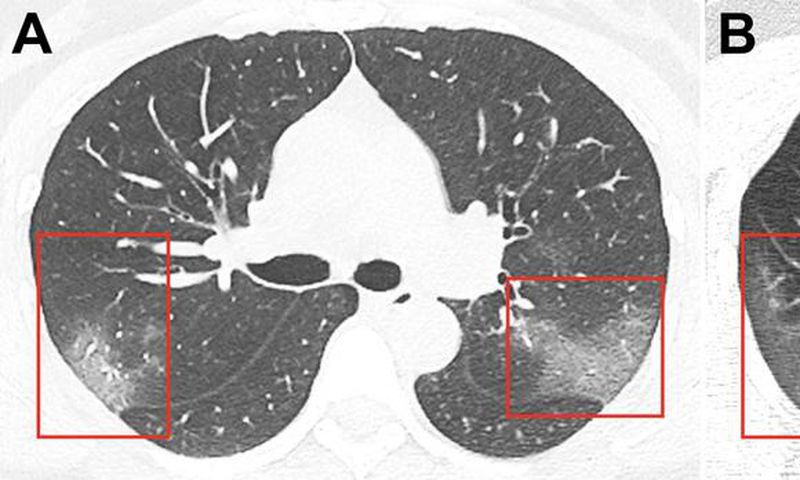 Coronavirus patient chest x ray