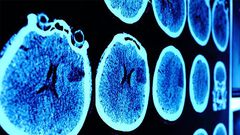 7 Brain Cancer Symptoms Every Woman Should Know