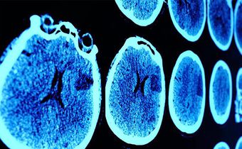 7 Brain Cancer Symptoms Every Woman Should Know