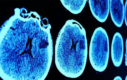 7 Brain Cancer Symptoms Every Woman Should Know