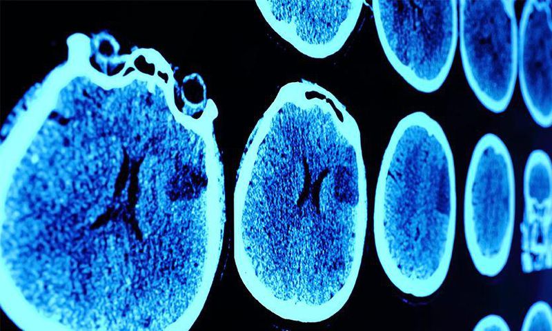 7 Brain Cancer Symptoms Every Woman Should Know