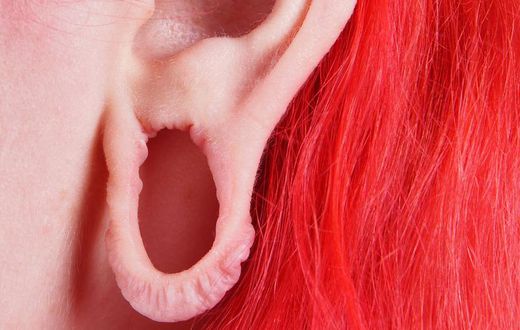 Dr. Pimple Popper Repairs a Stretched Earlobe