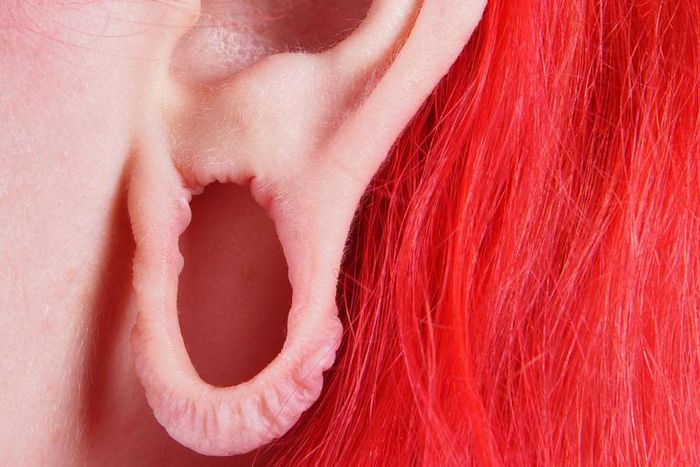 Dr. Pimple Popper Repairs a Stretched Earlobe