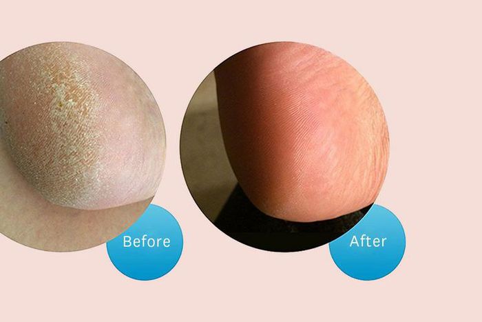 This Callus Remover Will Give You Baby-Soft Feet
