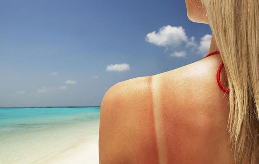 Here's How To Stop An Itchy Sunburn Fast