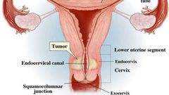 Cervical Cancer