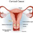 Cervical Cancer