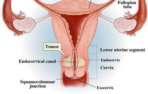 Cervical Cancer