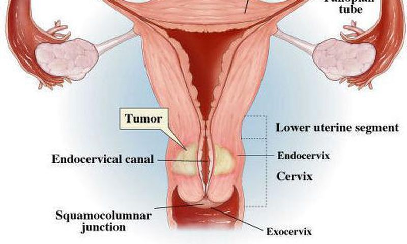 Cervical Cancer