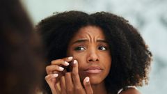 5 reasons why your acne never seem to disappear