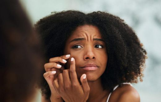 5 reasons why your acne never seem to disappear