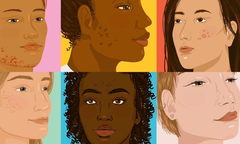 How to Cover Up Every Type of Acne