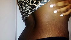 5 home remedies to treat stretch marks