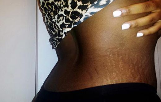 5 home remedies to treat stretch marks