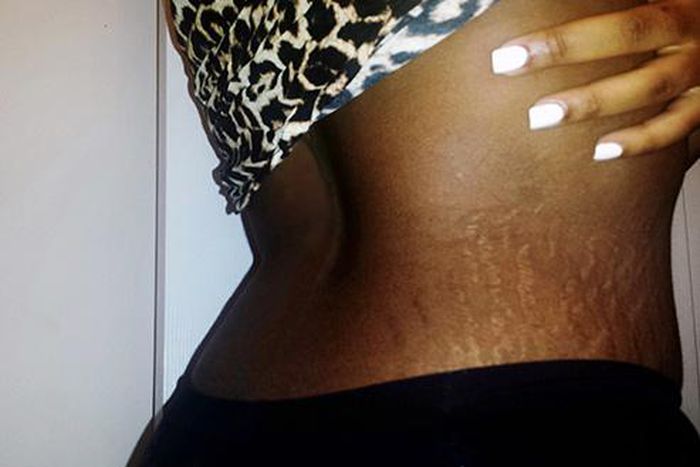 5 home remedies to treat stretch marks