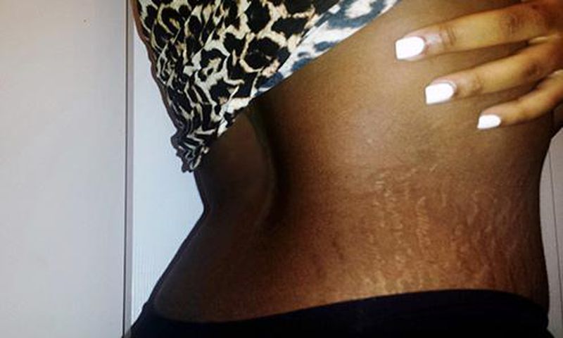5 home remedies to treat stretch marks