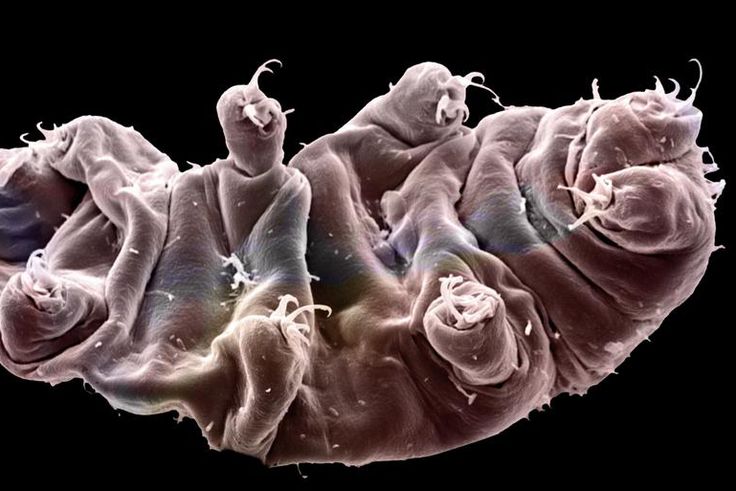 Dr. Pimple Popper Squeezes a 'Bug' Out Of a Cyst