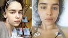 Emilia Clarke Shares New Pics After Brain Surgery