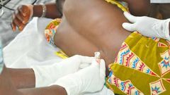 Upper West Region: CSM cases move up to 315 with 45 deaths