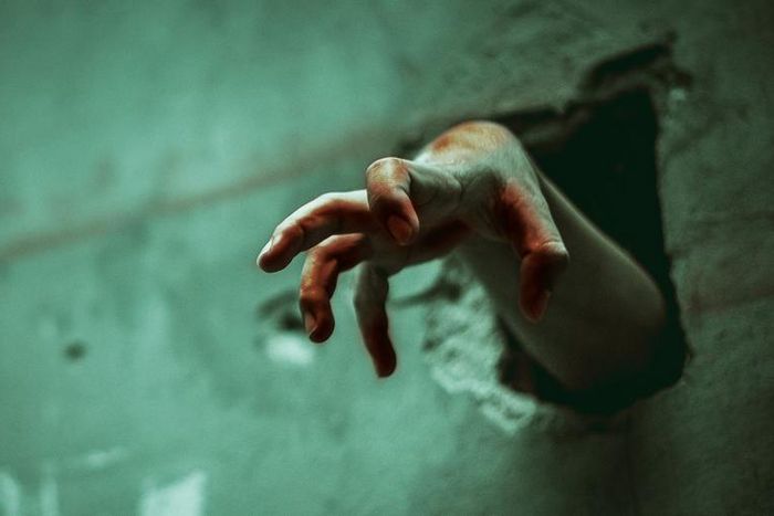 Watch Dr. P Squeeze 'Zombie' Scalp Cysts