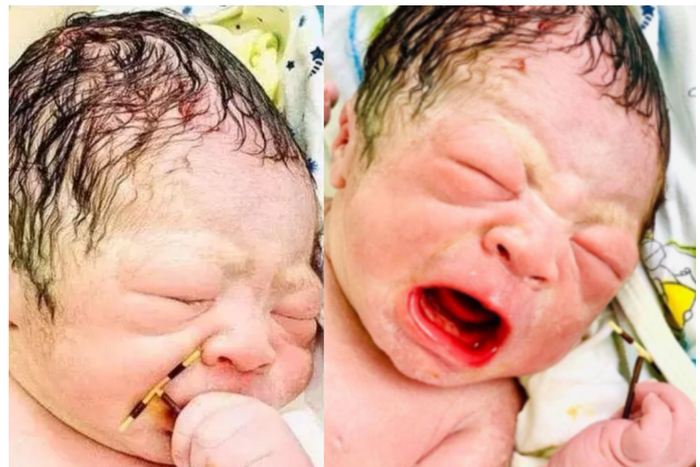 Baby comes out of mother’s womb holding failed family planning device firmly in his hand (photos)