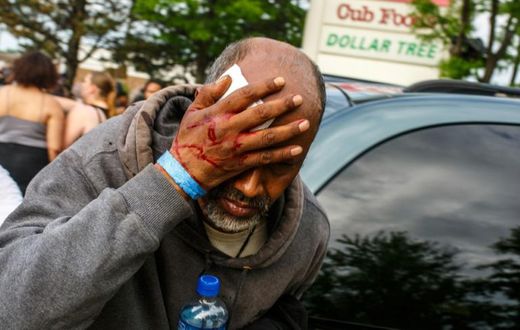 A Somali-American man injured when protesters clashed with police during demonstrations against the death of George Floyd in  Minneapolis on May 27, 2020 -- African refugees have joined the protests against racism