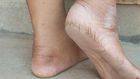 Cracked heels