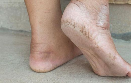 Cracked heels