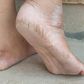 Cracked heels