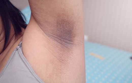 Dark underarm