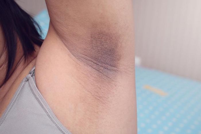 Dark underarm