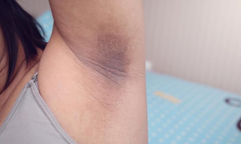 Dark underarm