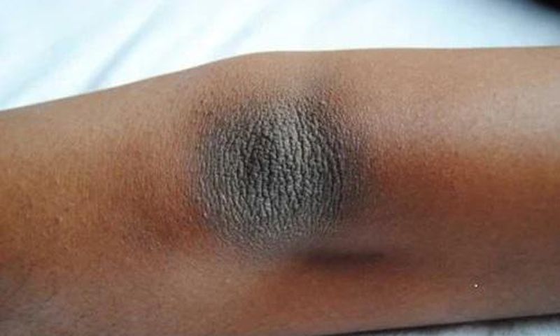 4 home remedies to get rid of dark knees and elbows