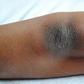 4 home remedies to get rid of dark knees and elbows