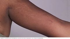 Woman dies after her heart exploded during Carboxytherapy to remove stretchmarks