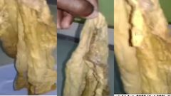 Ridge Hospital again? Doctors leave huge towel in woman’s tummy for 9 months after caesarian section (video)