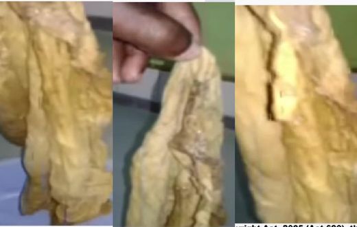 Ridge Hospital again? Doctors leave huge towel in woman’s tummy for 9 months after caesarian section (video)