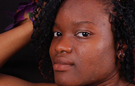5 natural ways to get rid of acne scars and pimple marks
